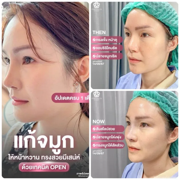 รีวิวแก้จมูก