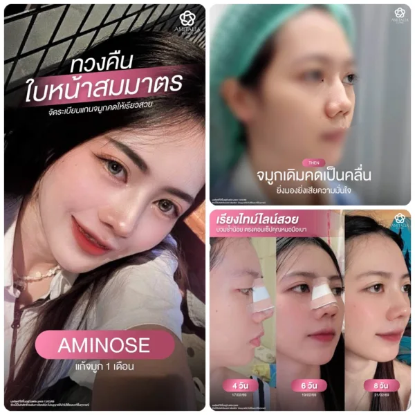 จมูกเดิมคด