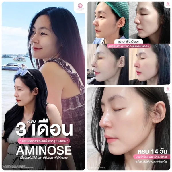บวมช้ำ