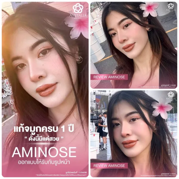 แก้จมูก