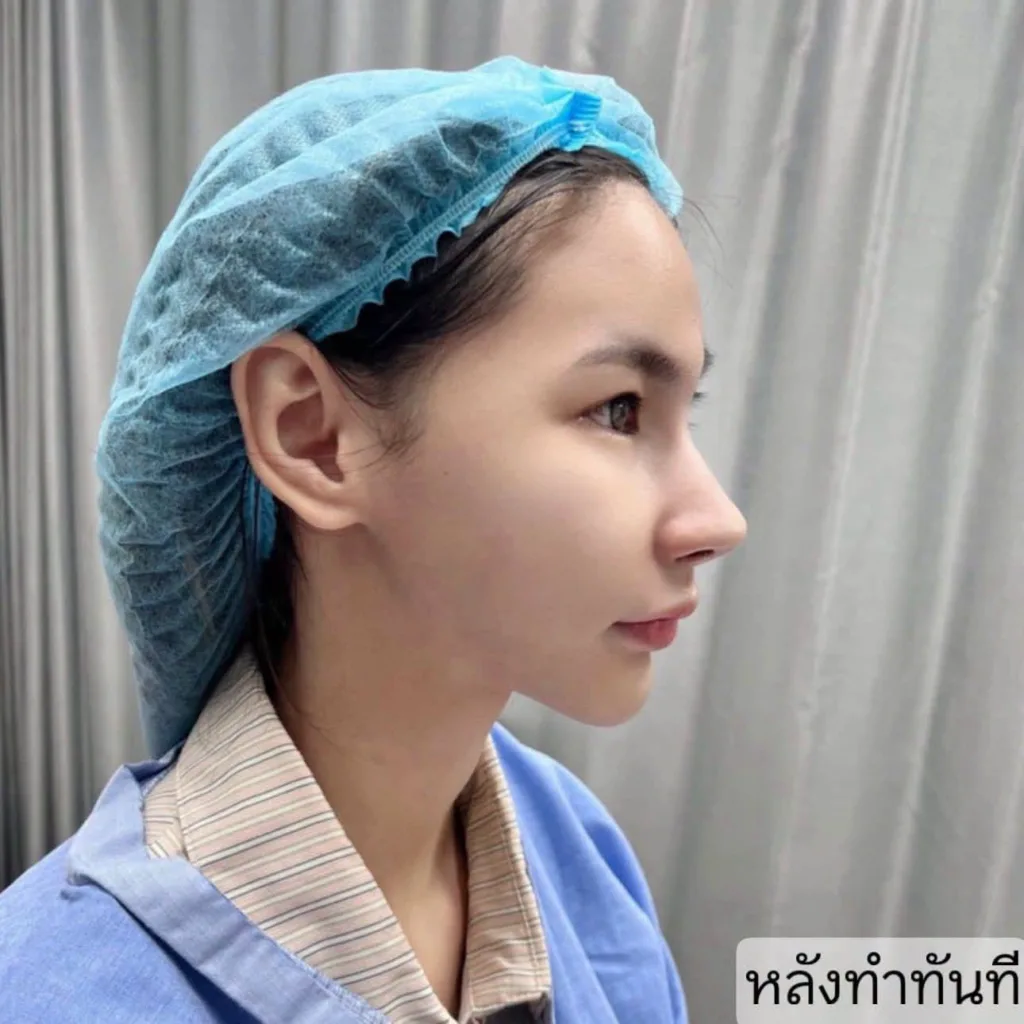 รีวิวเสริมจมูก