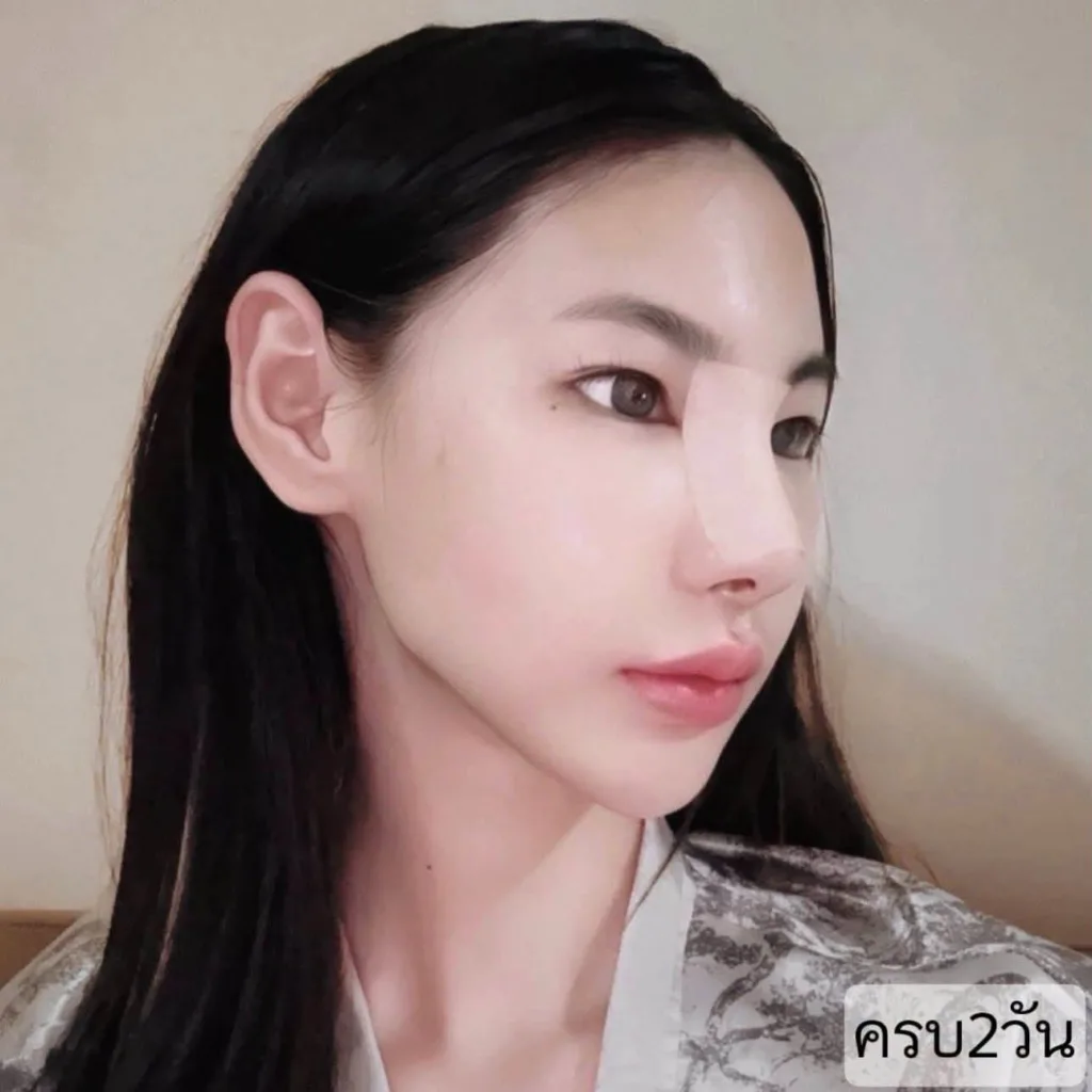 รีวิวเสริมจมูก