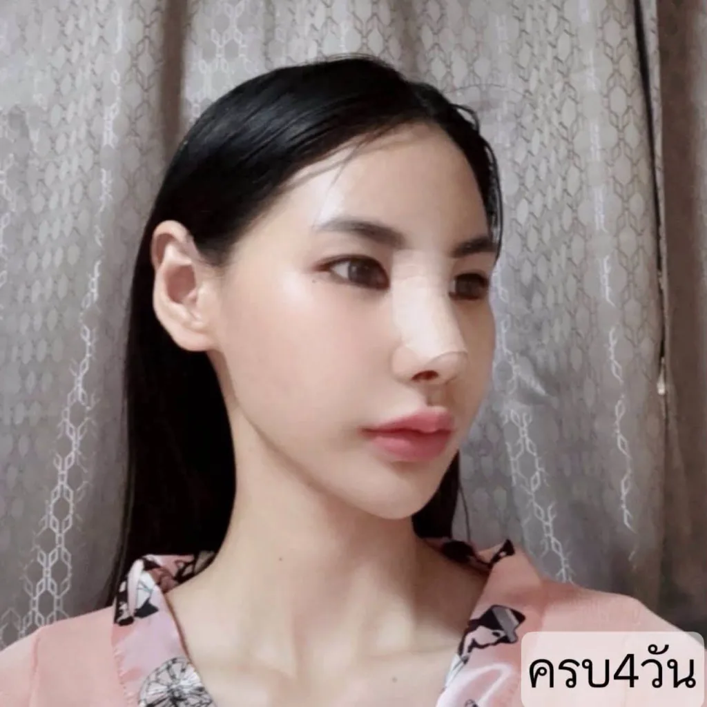 รีวิวเสริมจมูก